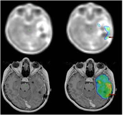 Relationship between Glioblastoma Dose Volume Parameters Measured by Dual Time Point Fluoroethylthyrosine-PET and Clinical Outcomes